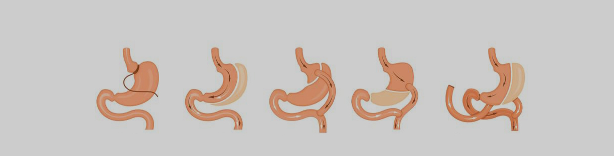 Bariatric Surgeries