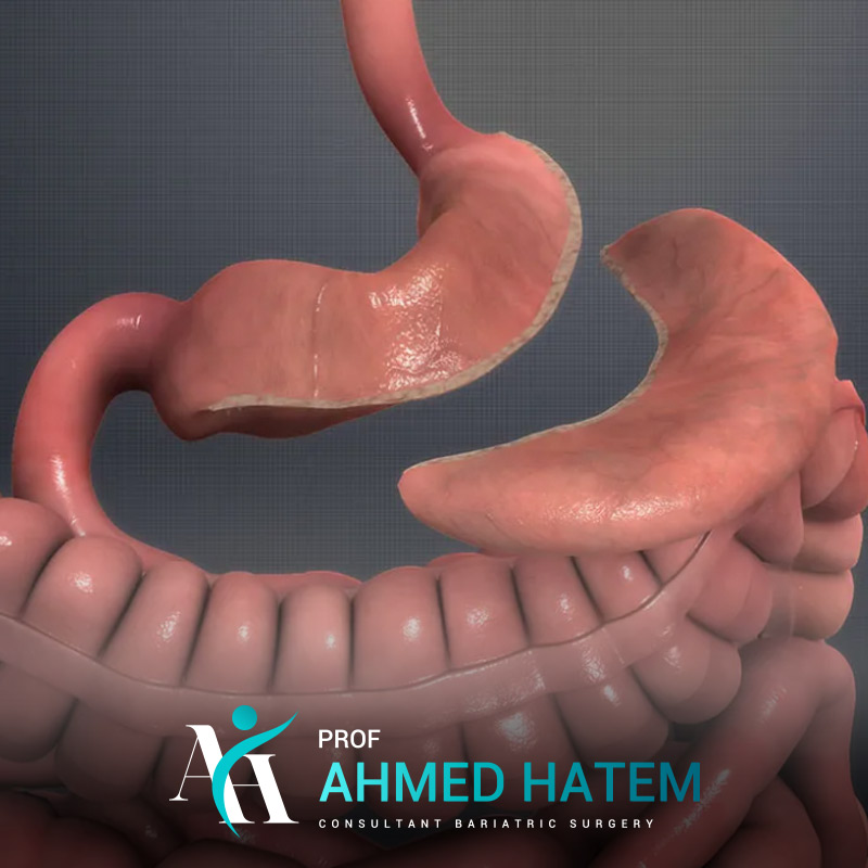 Gastric Sleeve Surgery
