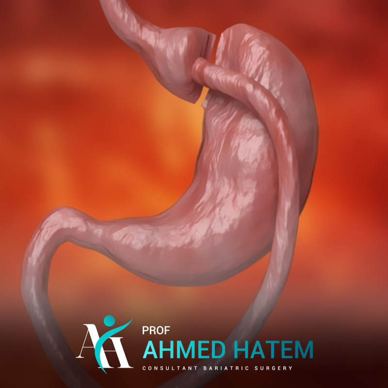 Gastric Bypass Surgery